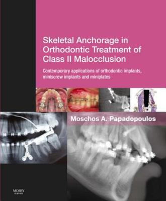 Skeletal anchorage in orthodontic treatment of class II malocclusion : contemporary applications of orthodontic implants, miniscrew implants and miniplates